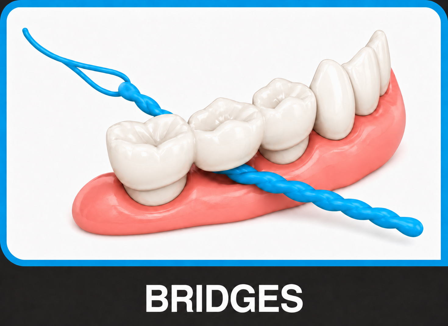 Diagram of X-Floss threaded under a bridge pontic, floss drawn through behind the threader