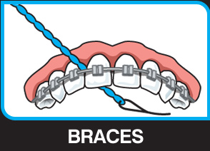 X-Floss Lite used under an orthodontic archwire with braces