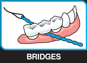 X-Floss Lite used under a narrow bridge pontic