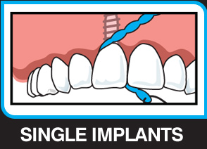X-Floss Lite used around a tight single implant contact