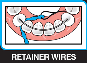X-Floss Lite used under a bonded retainer wire