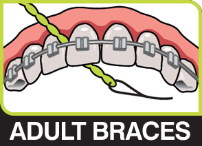X-Floss used under an orthodontic archwire with braces