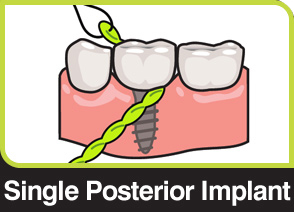 X-Floss used around a single posterior implant