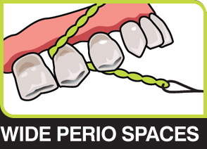 X-Floss used in a wide periodontal embrasure